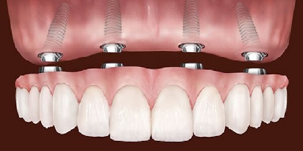 Протезирование на имплантах: как вернуть зубы к жизни без боли и ограничений